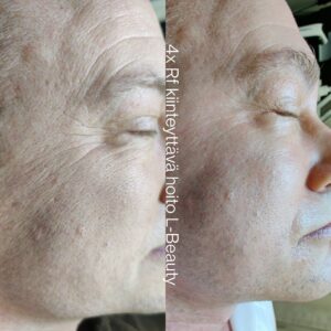 Kiinteyttävä kasvohoito Helsinki L-Beauty Kiinteyttävä kasvohoito Helsinki L-Beauty