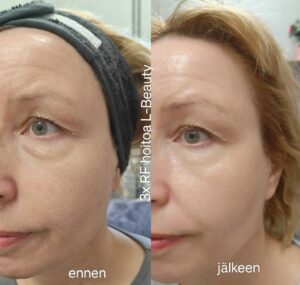 Silmäpussien hoito Silmäpussien hoito L-Beauty