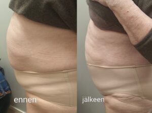 rasvanpoltto Hifu Liposonix