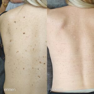 Rasvaluomien poisto selästä L-Beauty