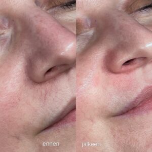 Diatermia, verisuonten poisto Helsinki