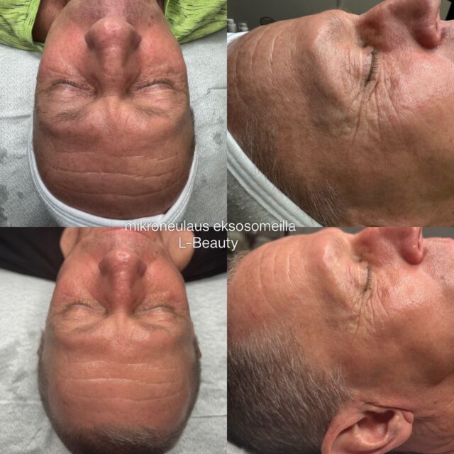 eksosomit ihonhoidossa L-Beauty