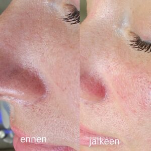 Hydrogen ihonpuhdistus